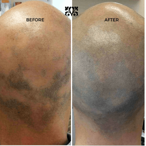 Alopecia Treatment